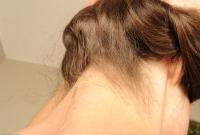 ATK hairy  in mature and hairy