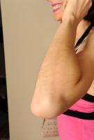 ATK hairy  in mature and hairy