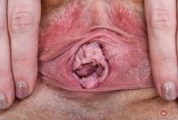 ATK hairy  in young and hairy