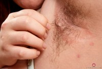 ATK hairy  in mature and hairy