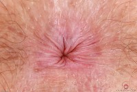 ATK hairy  in young and hairy
