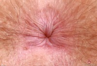 ATK hairy  in young and hairy