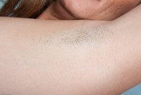 ATK hairy  in mature and hairy