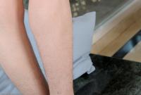 ATK hairy  in mature and hairy