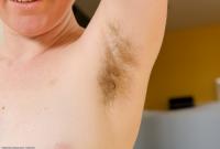 ATK hairy  in mature and hairy