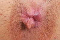 ATK hairy  in young and hairy