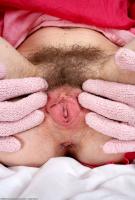 ATK hairy  in mature and hairy