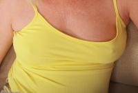 ATK hairy  in mature and hairy