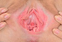 ATK hairy  in young and hairy