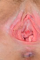 ATK hairy  in young and hairy