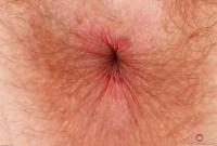 ATK hairy  in young and hairy