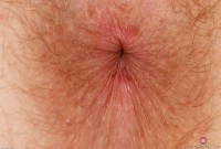 ATK hairy  in young and hairy