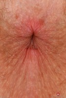 ATK hairy  in young and hairy