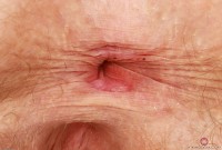 ATK hairy Apricot Pitts Set