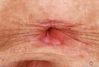 ATK hairy Apricot Pitts Set