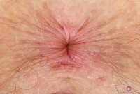 ATK hairy  in young and hairy