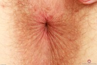 ATK hairy  in young and hairy