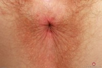 ATK hairy  in young and hairy