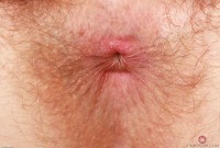 ATK hairy  in young and hairy