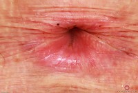 ATK hairy Apricot Pitts Set