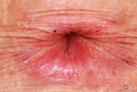 ATK hairy  in young and hairy