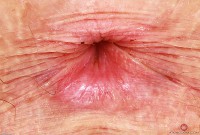 ATK hairy Apricot Pitts Set