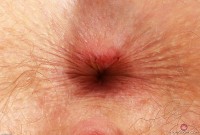 ATK hairy Apricot Pitts Set