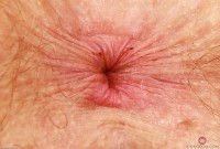 ATK hairy Apricot Pitts Set