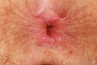 ATK hairy Apricot Pitts Set