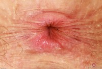 ATK hairy Apricot Pitts Set