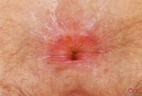 ATK hairy  in young and hairy
