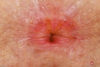 ATK hairy  in young and hairy