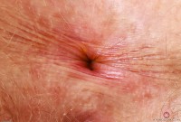 ATK hairy  in young and hairy