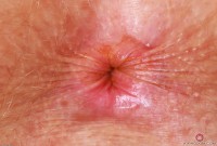 ATK hairy Apricot Pitts Set