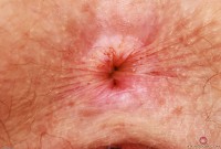 ATK hairy Apricot Pitts Set