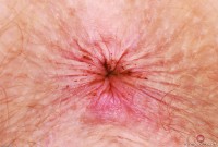 ATK hairy Apricot Pitts Set