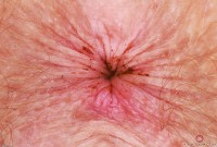 ATK hairy Apricot Pitts Set