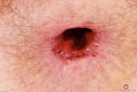 ATK hairy Apricot Pitts Set