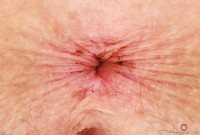 ATK hairy Apricot Pitts Set