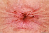 ATK hairy Apricot Pitts Set