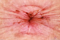 ATK hairy Apricot Pitts Set