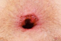 ATK hairy Apricot Pitts Set
