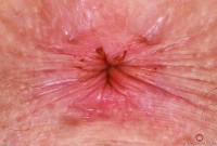 ATK hairy Apricot Pitts Set