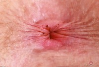 ATK hairy Apricot Pitts Set