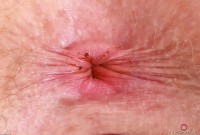 ATK hairy Apricot Pitts Set