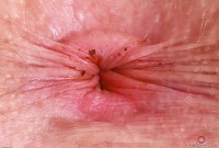 ATK hairy Apricot Pitts Set