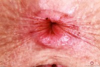 ATK hairy Apricot Pitts Set