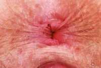 ATK hairy Apricot Pitts Set