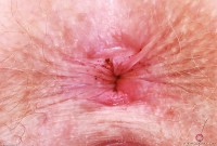 ATK hairy Apricot Pitts Set