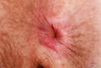 ATK hairy Apricot Pitts Set